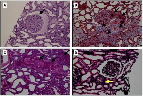 Figure 2 Classic renal pathology in scleroderma renal crisis. (A) The glomerulus demonstrates the global collapse of the glomerular capillary with bloodless appearance, finding similar to ischemic changes. There is no crescent or proliferative lesion (Hematoxylin and eosin stain, x400). (B) This figure shows extensive fibrinoid necrosis and fibrin thrombi in afferent arteriole and glomerulus (arrows), and mucoid intimal edema of small arteries (arrow heads) (Masson’s trichrome, original magnification x400). (C) Obliteration of arterioles and interlobular arteries (arrows) with thrombi (Periodic acid-Schiff stain, original magnification x400). (D) Intimal concentric lamination (arrow) or onion skin appearance of arteriole (Methenamine silver stain, original magnification x400).