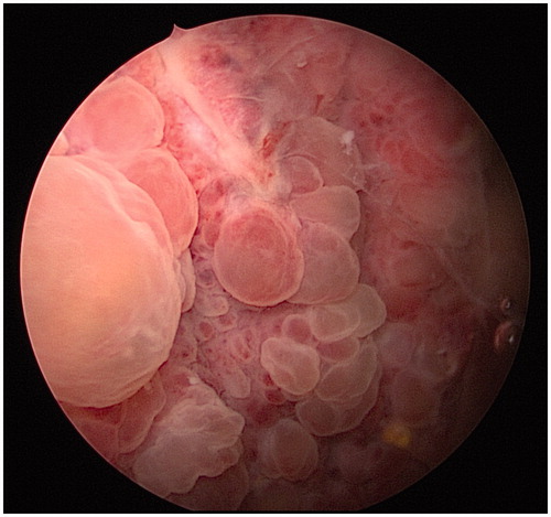 Figure 1. Cystoscopic view: edema blisters with a large area of distribution.