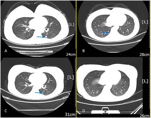 Figure 1. Pulmonary metastatic nodules on CT. CT images of the lung before chemotherapy, the largest pulmonary nodule is located in the left lung, with a diameter of 1.0 cm (A) and multiple nodules were seen (B). Shrinkage in the size of the pulmonary lesion pre-HIFU (C), the diameter of the lesion was 0.3 cm. Disappearance of the pulmonary nodules post-HIFU (D). CT, computed tomography; HIFU, high-intensity focused ultrasound.