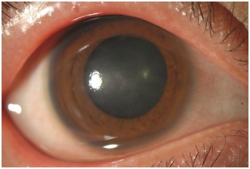 Figure 1 Photograph of a 32-year-old Japanese woman who exhibited radial keratoneuritis at the eleven and one o’clock positions in her right eye.