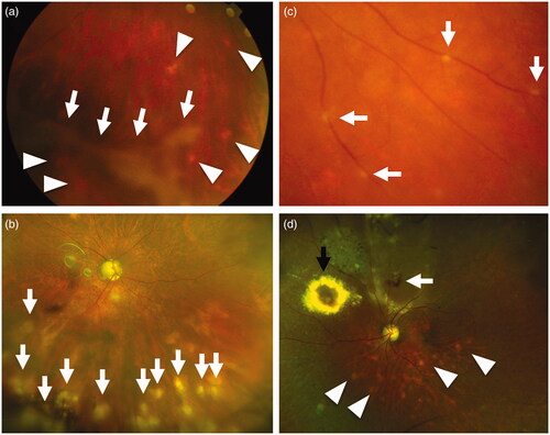 Figure 3. Posterior segment findings of ocular sarcoidosis. (a) String of pearl like vitreous opacity (arrows), and multiple chorioretinal lesions (arrowheads). (b) Fresh multiple chorioretinal lesions (arrows). (c) Nodular periphlebitis (arrows). (d) Multiple macroaneurysms surrounded by white hard exudates (arrows) and multiple chorioretinal lesions. (arrowheads).