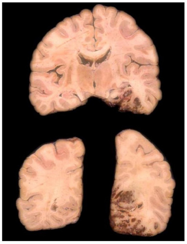Figure 1 Pathological specimen showing a hemorrhagic cerebral infarction of cardioembolic origin in the vascular superficial distribution territory of the posterior cerebral artery.