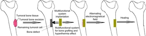 Figure 3 Schematic representation of bone cancer treatment by combined therapy (surgery and hyperthermia).Note: With kind permission from Springer Science+Business Media: J Mater Sci—Mater M., Synthesis and characterization of collagen/hydroxyapatite:magnetite composite material for bone cancer treatment. 21, 2010, 2237–2242, Andronescu E, Ficai M, Voicu G, Ficai D, Maganu M, Ficai A, figure 2.Citation116