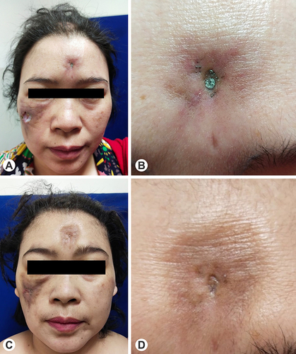 Figure 1 Clinical manifestations of LEP in the patient. (A) Multiple cutaneous ulcer and scarring alopecia. (B) Serous crust overlying indurated erythematous plaque on the forehead. (C and D) Clinical improvement after three months of follow up.