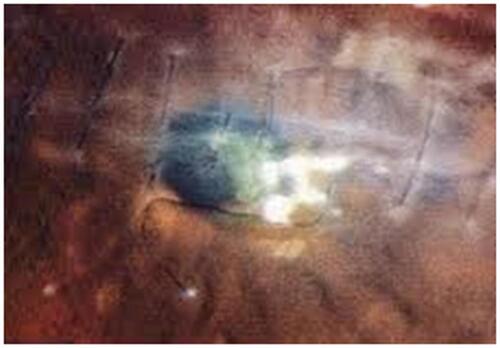 Figure 3 Photograph of Klebsiella oxytoca-induced infectious keratitis showing formed scar from ulcer and scar around removed stitch at final follow-up.