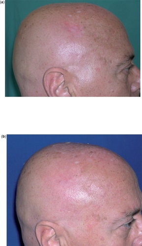 Figure 1 Superficial BCC of the scalp before (a) and after (b) 8 weeks of treatment with IQ 5% cream 5 applications/week: complete clearance.