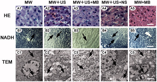 Figure 3. Microscopy images of selected tissue specimens in normal rabbit livers. (A) HE-stained images under the same magnification time (400 ×). Scale bar: 25 μm. (B) NADH-stained images under the same magnification time (40 ×). Scale bar: 250 μm. B1, B5, normal liver tissues are stained (black arrows). B3, non-staining is shown in the ablated zone (black arrow). B2, B4, black arrows represent the boundaries of necrosis (black arrows). (C) TEM images of the same magnification time (15 000 ×). Scale bar: 1.5 μm. C1, C5, integrated nuclear membrane and intact mitochondria (black arrows). C2, C4, swollen mitochondria and vacuolar degeneration (black arrows). C3, remnants of nuclear fragments and disappeared organelles (black arrows).