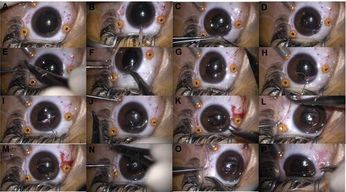 Figure 1 Intrascleral knotless zigzag suture fixation of Akreos AO60 foldable intraocular lens (IOL) technique. (A) Conjunctival peritomy at 3 and 9 o’clock to expose the sclera. (B) Limbus corneal incision at 12 o’clock. (C) One haptic is externalized through the corneal incision. (D) A double thread 10-0 or 9-0 polypropylene suture is passed through the eyelet. (E) The needle is passed between the arms of the thread. (F and G) The needle is inserted through the corneal incision, passed behind the iris, and came out through the sclera at about 2 mm from the limbus. (H and J) The steps are repeated using the 180º away haptic and orienting the needle to the opposite side. (K) Centration of the IOL. (L–O) The suture is run through the partial thickness of the sclera in a zigzag pattern (4 intrascleral passages), and the thread is cut flush to the sclera without knotting (this procedure is performed in the nasal and temporal sides). (P) Conjunctival suture.