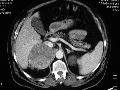 Figure 1 Abdominal computed tomography shows a 10-cm right adrenal lesion.