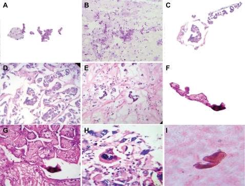Figure 3 The crystal comet effect tail generates alignment of fractal embryoid bodies. A shows a detachment subimage of B, demonstrating fractal embryoid body alignment emerging from a hexagonal core geometric organization in a case of Grade 1 cervical intraepithelial neoplasia with Papanicolaou staining (10×); C is a detachment subimage of D which is a micrograph displaying assembly of well-defined fractal embryoid bodies in a case of gastric adenocarcinoma with hematoxylin and eosin staining (20×); E is a micrograph displaying assembly of well-defined fractal embryoid bodies in a case of colon adenocarcinoma with hematoxylin and eosin staining (20×); F is a detachment subimage of G, which shows a mirror image of well-defined fractal embryoid bodies in a case of renal cell carcinoma with hematoxylin and eosin staining (20×); H shows a fractal embryoid body in a case of undifferentiated sarcoma tumor with hematoxylin and eosin staining (20×); I shows self-assembled embryoid body with a well-defined pattern of formation in a necrotic area of leiomyosarcoma, with hematoxylin and eosin staining (20×).