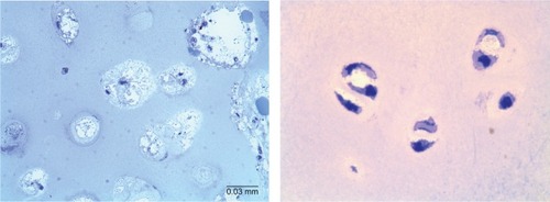 Figure 1 Bone pathology of the iliac crest in a 17-year-old patient with MPS IVA after clinical trial.