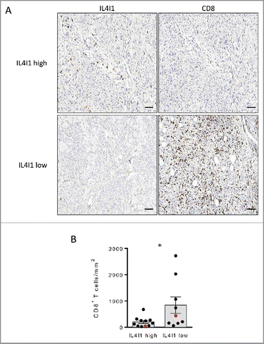 Figure 5. Primary tumors poorly infiltrated by IL4I1+ cells exhibit an enhanced density of CD8+ T cells in melanoma patients (A) Representative stainings of CD8+ and IL4I1+ cells infiltrating melanoma tumors. Scale bar, 100 µm. (B) Quantifications of CD8+ T cell density in low (n = 9) or high (n = 11) IL4I1-infiltrated tumors (corresponding to < or > of the median value of IL4I1+ cell density). Each point corresponds to a primary tumor. Red symbols display the representative images in A. Bars depict mean ± SEM. Unpaired t test; *p < 0.05.