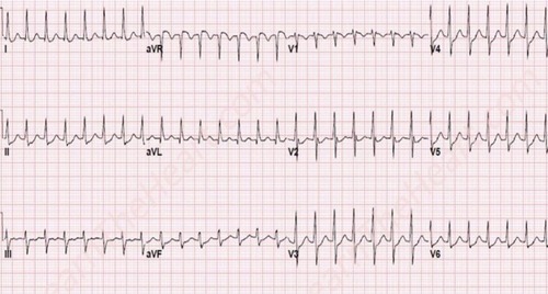 Figure 2 Twelve-lead electrocardiogram showing supraventricular tachycardia with a regular, narrow QRS tachycardia at a rate of 170 bpm, during which the P wave was indiscernible, in a patient with dextroposition of the heart.
