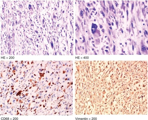 Figure 2 HE staining showing tumor cells with CD68 and vimentin-positive expression (×200 and ×400).