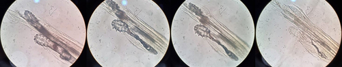 Figure 4 Two mites covered with follicular keratin stopped moving and died within 2 min after exposure to lemongrass oil. The mites shrank, distorted, and became transparent within 30 min after death.