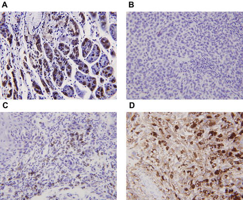 Figure 4 Expression of the α-subunit of H+/K+-ATPases (proton pumps) in laryngeal carcinomas as revealed by immunohistochemical staining. (A) Gastric control tissues exhibited strong staining for the α-subunit. (B) The α-subunit was not expressed in paracarcinoma tissues. (C) The α-subunit was not expressed in laryngeal carcinomas. (D) Positive staining (brown) is evident in both the cytoplasm and plasma membrane of laryngeal carcinoma cells.