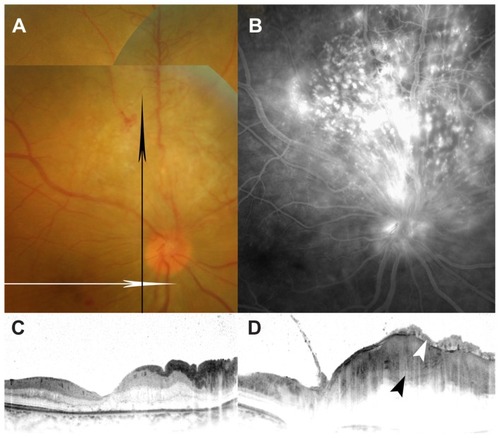 Figure 2 Color fundus photograph, fluorescein angiographic image, and spectral-domain optical coherence tomographic (OCT) images after six intravitreal injections of bevacizumab. The best-corrected visual acuity improved to 0.3. (A) Fundus photograph demonstrates marked regression of neovascular vessels, retinal hemorrhage, and exudative change. The direction of the OCT scan is indicated by a white arrow (C) or a black arrow (D). (B) Late-phase fluorescein angiography reveals decreased leakage from neovascular vessels. (C) Horizontal OCT image through the fovea shows disappearance of the serous retinal detachment. (D) Vertical OCT image through the elevated lesion shows a retinal tumor located on the retinal surface (black arrowhead) and epiretinal membrane (white arrowhead).