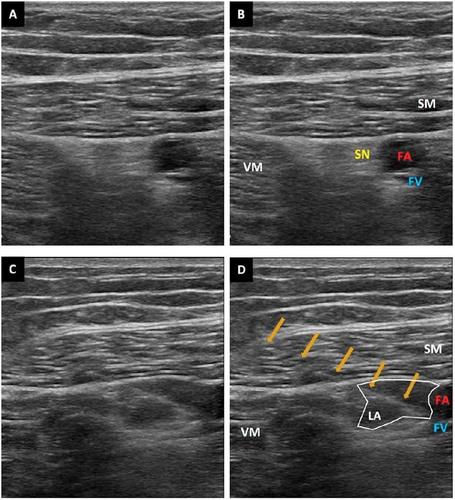 Fig. 1 Ultrasound guided demonstration of the adductor canal block: A and B: ultrasonographic anatomy of the adductor canal: FA (Femoral artery), FV (Femoral Vein), SN (Saphenous nerve), SM (Sartorius muscle), VM (Vastus Medialis). C and D: ACB: needle location indicated by arrows with local anesthetic (LA) deposited in the adductor canal.