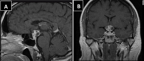 Figure 2 MRI sagittal (A) and coronal (B) T1 showed heterogeneous enhancing mass arising from pituitary fossa consistent with macroadenoma.