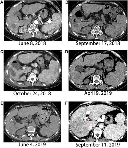 Figure 3 Evolution of the primary liver lesion on computed tomography. (A) Liver lesion in Segment 6 at admission, (B and C) Changes in the segment 6 lesion post-microwave irradiation, (D and E) The tumor continually progresses. (F) Main portal vein tumor thrombus emerges. Red arrow indicates main portal vein tumor thrombus.