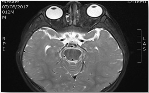 Figure 6 T2 weighted image, axial view of head and orbit, showing homogenous isointense lesion, seen at superomedial aspect of left globe causing mild lateral proptosis of left eye globe.