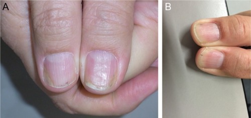 Figure 4 There is residual nail bed psoriasis under methotrexate therapy. Finally, a biological treatment is instituted.
