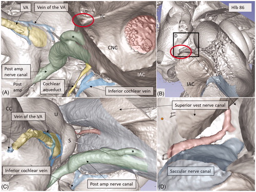 Figure 10. Micro-CT and 3D rendering of a left human temporal bone after virtual molding of the labyrinth using surface enhancement and coronal cropping. (A) The 3D view of a cropped human labyrinth at the level of IAC. The removal of bone and surface enhancement reveal both vascular structures and nerve canals. The cochlear aqueduct and the inferior cochlear vein can be seen. (B) The cochlea is sectioned horizontally near the foramen of the TC (red circle). This channel seems to house a vessel or artery which supplies both the utricle and the saccule. Framed area is shown in higher magnification in (D). (C): Lateral view of the IAC showing the channel of the TC (red). The VA and the accessory canal housing the vein of the VA are identified. CNC: cochlear nerve canal; CC: common crus; S: saccule; TC: transverse crest; U: utricle; *accessory singular nerve canal.