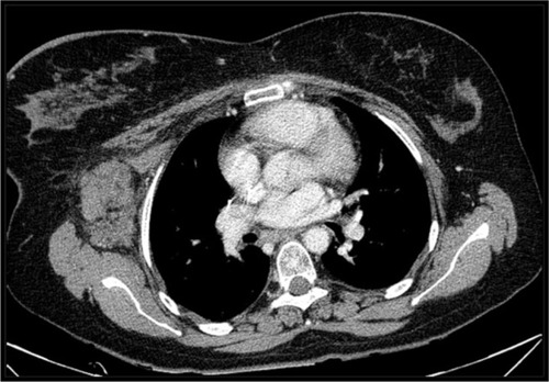 Figure 1 CT scan showing an axillary node transiently controlled with radiotherapy in June 2009.