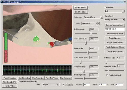 Figure 5. An example of interactive feedback in the simulator, with the bone removal metric selected. Bone removed by the user at the far right that was removed by less than 20% of the experts (as parameterized in the “Prob” text box in the bottom right corner) is shown in red, while bone in the center that was removed by a higher percentage of the experts is shown in green. The bar at left shows the relative proportion of correctly (green) and incorrectly (red) removed bone. [Color version available online.]