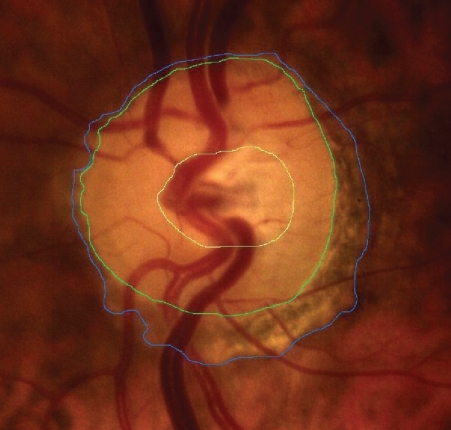 Figure 2 Mapping of cupping, disc and peripapillary atrophy.