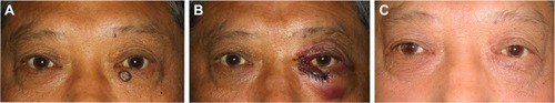 Figure 1 A patient with BCC on the left lower lid.