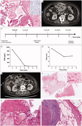 Figure 1. (A) Biopsy of the treatment-naïve transverse colon adenocarcinoma [HE ×200], which was deficient in MLH1 and PMS2 by immunohistochemistry (inset, MLH1, ×200). (B) Axial computed tomography (CT) images showing a 7.4 cm transverse colon tumour invading into small bowel. (C) Timeline of events from point of diagnosis to surgical resection with administration of five cycles of neoadjuvant pembrolizumab at monthly intervals. Between the 2nd and 3rd doses, she was hospitalised for respiratory compromise secondary to atelectasis and bronchitis which was deemed unrelated to ongoing therapy. (D) Plot of serial serum CEA levels (µg/L) measured before and during neoadjuvant therapy. (E) Plot of interval tumour size (cm) measured on computed tomography (CT) imaging before and during neoadjuvant therapy. (F) Axial CT showing downsizing of the primary tumour to 4 cm after two cycles of pembrolizumab. (G) Ultra-low power view of regressed tumour bed with adherent small bowel (colonic tumour site marked with blue arrows, small bowel marked with green arrowheads, omentum with *) [HE, ×0.25], showing copious amounts of acellular mucin (inset, HE ×100) extending transmurally into the adherent small bowel. (H) Low magnification of the primary tumour bed showing luminal erosions and underlying transmural mucin [HE, ×1]. (I) Acellular mucin within a lymph node [HE x40]. The post-pembrolizumab histology corresponded to AJCC 8th edition pathologic stage ypT0N0M0R0, tumour regression grade (TRG) 0/3.