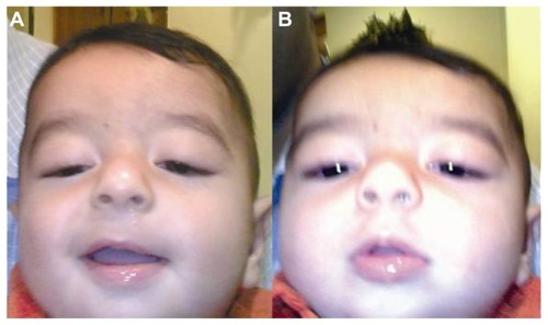 Figure 3 Preoperative presentation of bilateral hypotropia bilateral pseudoptosis (A) in Case 3, with chin-up head posture to fixate (B).