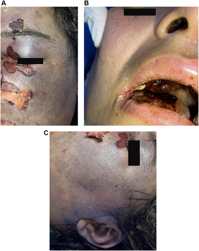 Figure 3 Facial swelling, periorbital edema, and erythema which are more prominent on the left side (A). Necrotic eschars on the palate (B). The black eschar extended to the left auditory side (C).