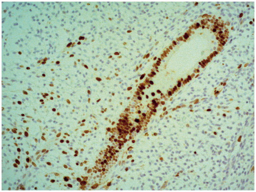 Figure 2. Patient L., 36, average grade of chronic hepatitis C. 16th day of the menstrual cycle. IHC verification of Ki-67 marker, magnification 200×. Intensive staining of the epithelium of glands, in the stroma, a small amount of cells with mitotic activity.