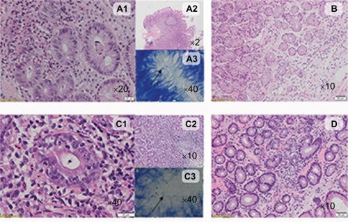 Figure 4 The typical histological characteristics of Hp+ gastritis and Hp− gastritis in celiac and nonceliac patients.