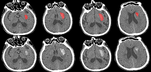 Figure 3 Representative image of hematoma by automatically labeled. The effect of the automatic hematoma labeling tool on a certain patient. The red color in the above picture shows the range of the labeled hematoma, and the picture below shows the original axial image of the brain.