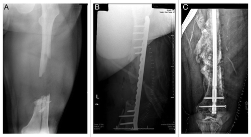 Figure 4: (A) AP radiograph of a large, segmental femur fracture with a sizeable diaphyseal defect. (B) postoperative AP radiograph of the fracture following bridge plating and implantation of iliac crest bone graph, DBM and BMP. (C) AP radiograph taken ten months following injury showing expansive bone formation and subsequent hypertrophic nonunion following hardware failure, treated with rigid intramedullary fixation.