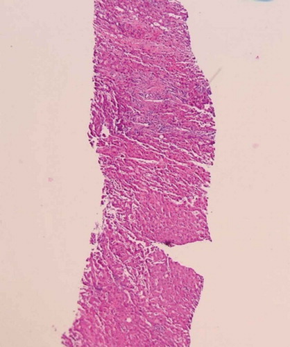 Figure 2. Histopathology of uterine mass revealing it be a rhabdomyosarcoma.