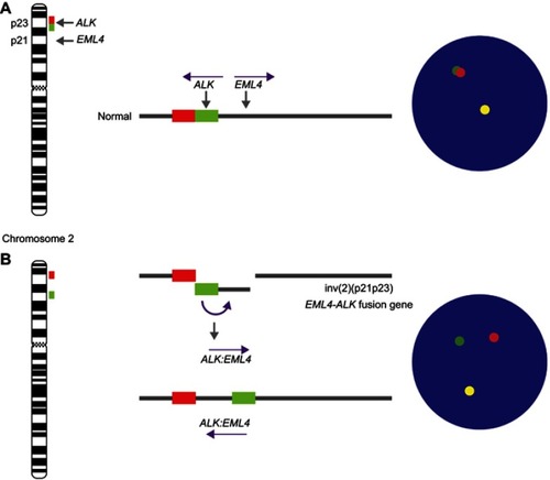 Figure 4 ALK Break-Apart FISH Probe for testing for the presence of EML4 (2p21) - ALK (2p23) fusion gene (ALK rearrangement) in lung cancers. The ALK break-apart probe is typically designed by labeling the 3ʹ (telomeric) part of the fusion breakpoint with one fluorochrome (orange signal) and the 5ʹ (centromeric) part with another fluorochrome (green signal). (A) In normal cells, the genomic areas homologous to the 3ʹ and 5ʹ probes are molecularly very close and these signals are seen as fused or adjacent. In contrast, (B) in abnormal cells, as result of the paracentric inversion on short arm of chromosome 2 (inv(2)(p21p23)), a gene fusion occurs between the AML and ALK genes. When the EML4-ALK fusion gene is present, the 5ʹ ALK green signal becomes far removed from the 3ʹ ALK red signal (by approximately 12.5 Mb), and the signals are seen as being split. The inv(2)(p21p23) is present when a green/orange fusion signal, specific for ALK, splits into separate green and orange signals.Abbreviations: ALK, anaplastic lymphoma kinase gene; EML4, echinoderm gene associated with microtubules 4 gene; inv, chromosomal inversion.