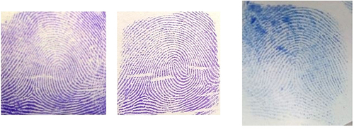 Figure 4 Different finger print patterns of study participants Gedeo Zone governmental hospitals, Southern Ethiopia.