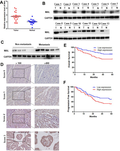 Figure 6 Experimental verification of the prognostic value of MAL. (A) PCR results of the 20 paired UCEC tumor and adjacent tissues. mRNA expression level of MAL in tumor tissues was significantly higher compared with that in adjacent normal tissues. (B) MAL protein level was significantly higher in tumor tissues compared with that in adjacent normal tissues. (C) MAL protein level was significantly higher in UCEC metastasis group compared with the non-metastatic group. (D) Representative pictures of UCEC in tissue microarray analyzed using IHC. (E and F) MAL high expression group was associated with worse overall survival and progression free survival.