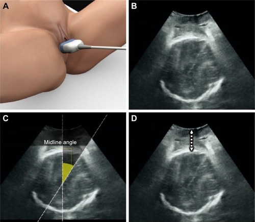 Figure 7 Technique for transperineal ultrasound scan for fetal head descent and rotation assessment on the axial plane.