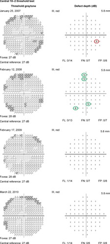 Figure 1 Four consecutive 10–2 visual fields with a red target in a patient taking hydroxychloroquine without retinopathy.