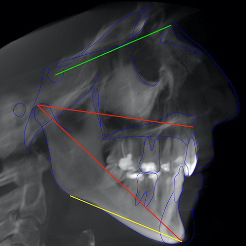 Figure 1 A CBCT-derived lateral cephalogram showing SN-GoGn angle (red), and effective length of maxilla (green), and effective length of mandible (yellow).