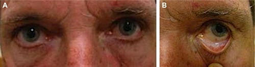 Figure 1 (A) Clinical photograph showing no globe displacement or ocular abnormalities. (B) Additional clinical photograph demonstrating no mass on visual inspection.