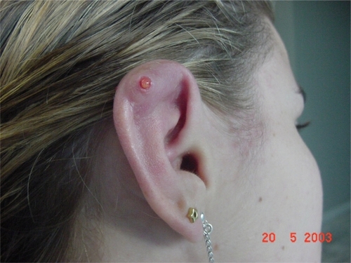Figure 6A Cartilage destruction after piercing due to an inflammatory reaction.