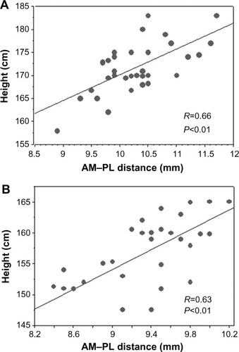 Figure 3 Relationships between anteromedial (AM) and posterolateral (PL) center distances and body height.Notes: (A) Good correlation (R=0.66) was seen between the two parameters in males (P<0.01). (B) In addition, in females, good correlation (R=0.63) was seen between the two parameters (P<0.01).