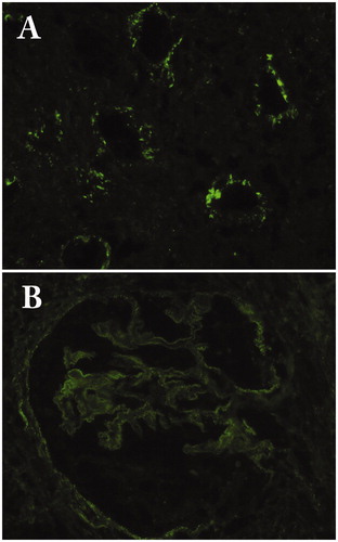 Figure 4. Immunofluorescence findings. (A) Granular deposits of C1q in the tubular basement membrane (×200); (B) Granular deposits of IgG4 in the glomerular basement membrane in IgG4-related membranous glomerulonephritis (×400).