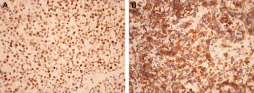 Figure S1 (A) MYC protein expression was exclusively brown nuclear (×400). (B) BCL-2 protein expression was exclusively brown cytoplasm (×400).